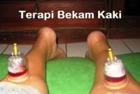 Terapi bekam kaki