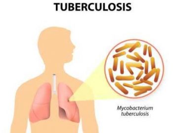 Terapi penyakit TBC