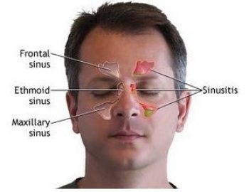 Terapi sinusitis